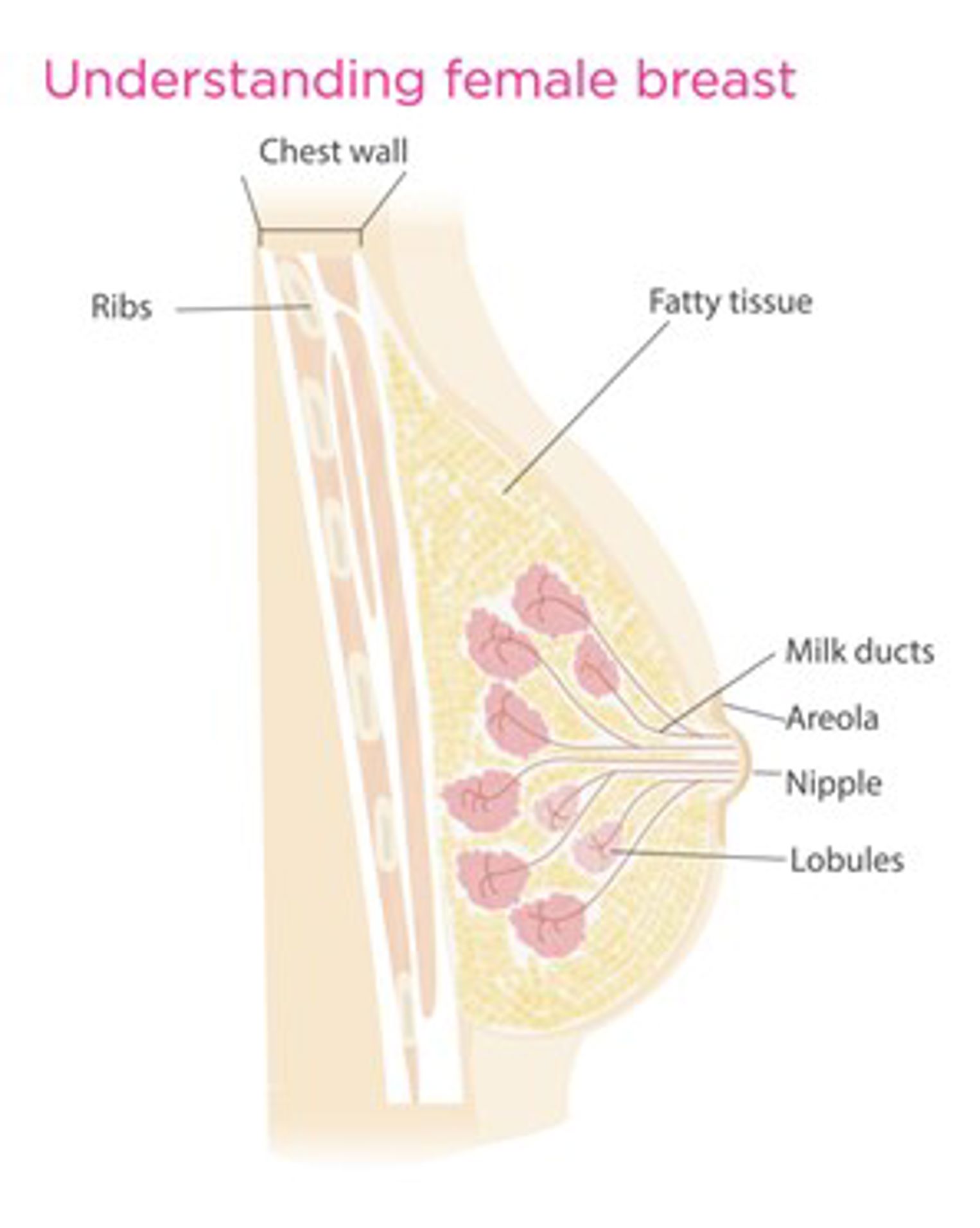 Diagram of a female breast, showing the location of the tissue, sacs and lobules