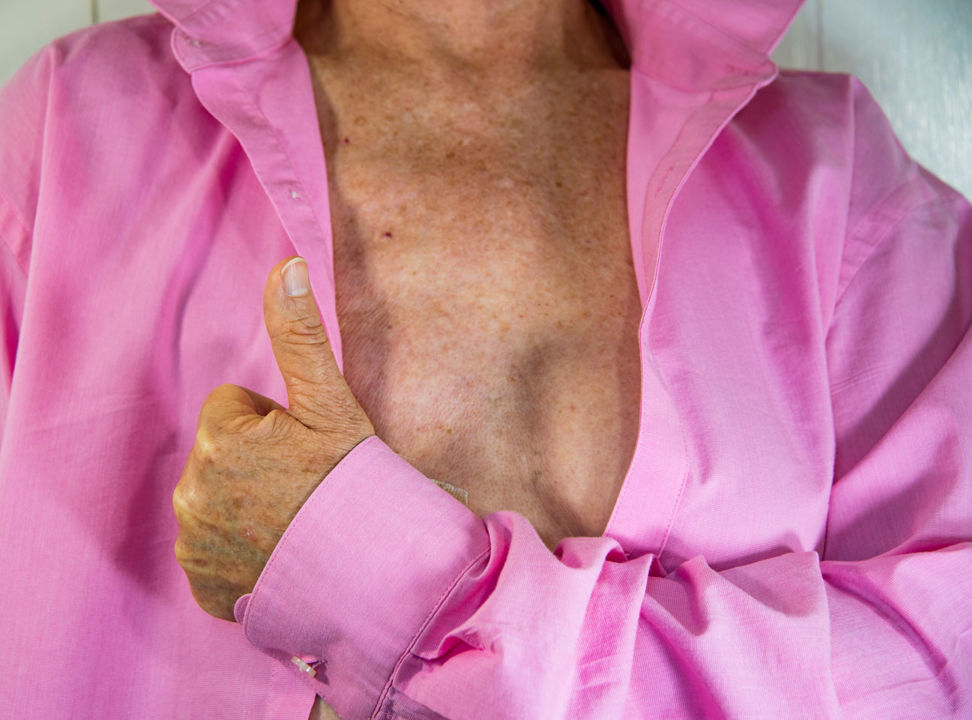A woman persons is wearing a pink shirt. The shirt is slightly open and shows a scar from surgery. 