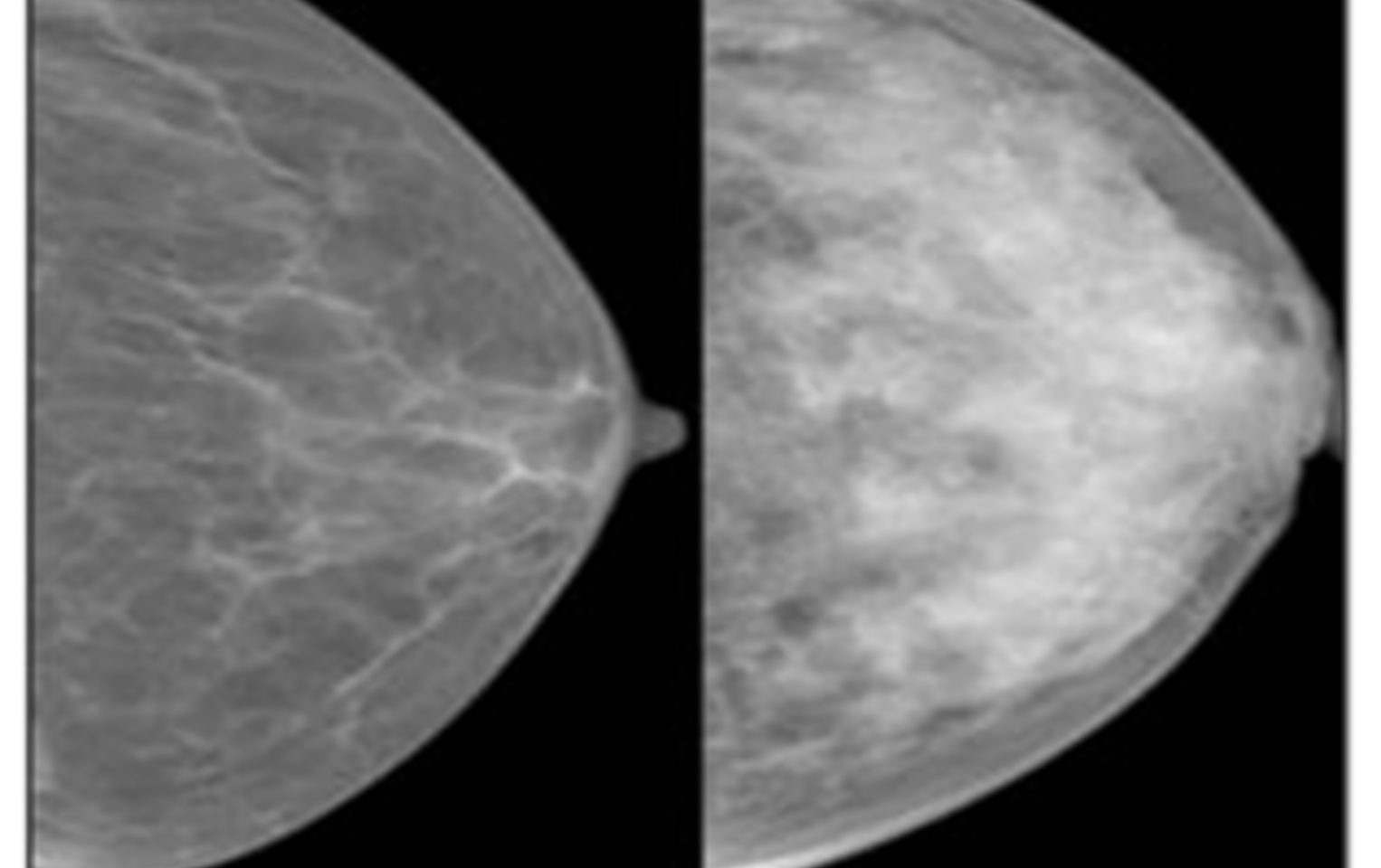 Image showing two mammograms. One is a darker colour for the fatty breast, the other is a lighter colour for the dense breast 