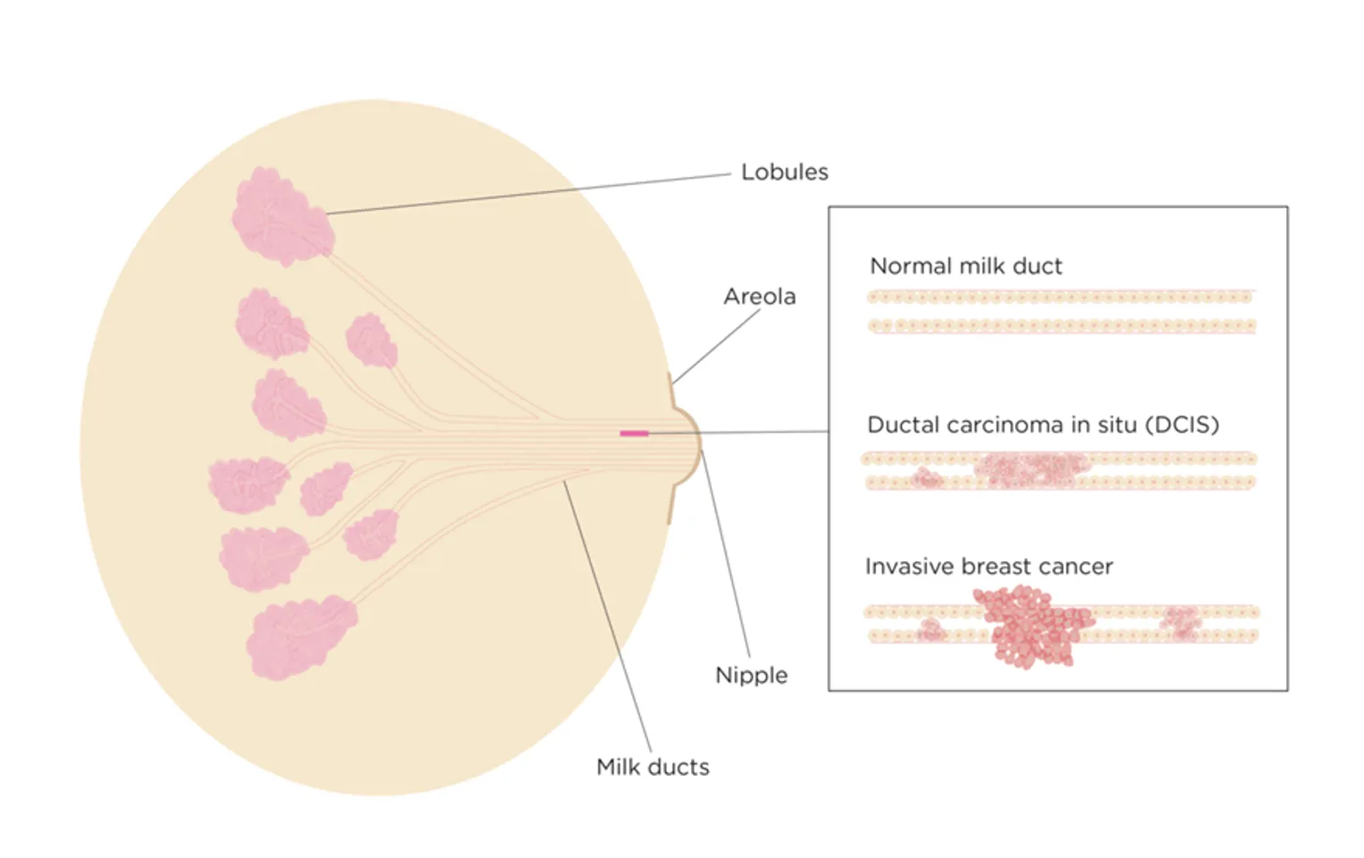 Illustration of a breast showing the different state of cells in the milk ducts.